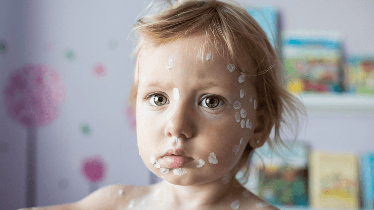 Babies will receive the chickenpox vaccine when they’re 12 months old Babies will receive the chickenpox vaccine when they’re 12 months old