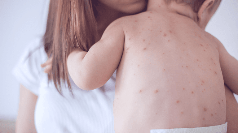 Warning issued after suspected case of measles at Dublin creche Warning issued after suspected case of measles at Dublin creche