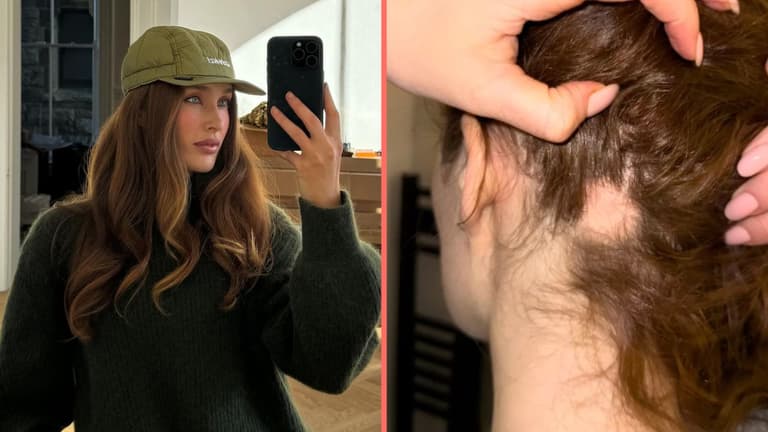 Roz Purcell issues new alopecia update following ‘bad patch’ Roz Purcell issues new alopecia update following ‘bad patch’