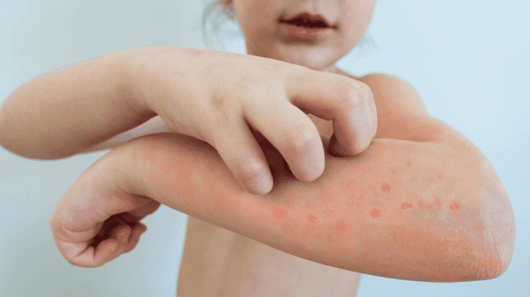 Advice issued to pregnant women amid chickenpox outbreak in Ireland Advice issued to pregnant women amid chickenpox outbreak in Ireland