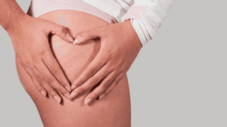 Irish aesthetician explains key to treating stretch marks effectively Irish aesthetician explains key to treating stretch marks effectively