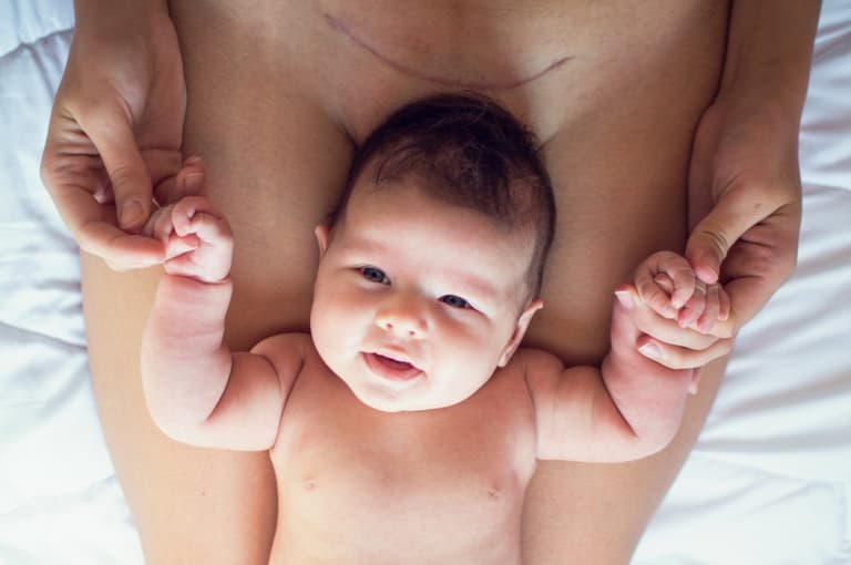 The effects of a C-section last much longer than you think, a new study has found The effects of a C-section last much longer than you think, a new study has found