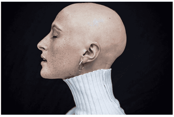 Stunning Irish model with alopecia covers magazine totally hair-free Stunning Irish model with alopecia covers magazine totally hair-free