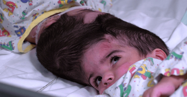 Conjoined twins successfully separated following 50 hour surgery in London Conjoined twins successfully separated following 50 hour surgery in London