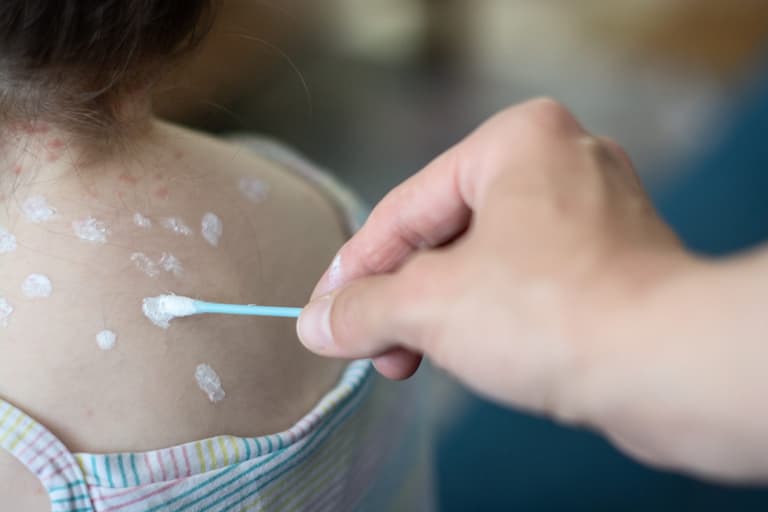 Chickenpox vaccine might be free after public consultation Chickenpox vaccine might be free after public consultation