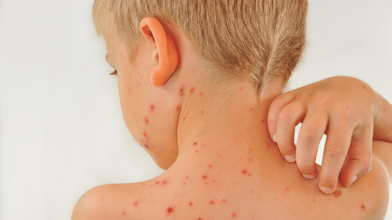 Parents urged to be ‘Chickenpox Aware’ following recent figures Parents urged to be ‘Chickenpox Aware’ following recent figures