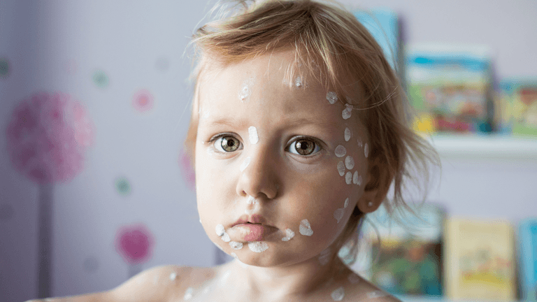 Babies will receive the chickenpox vaccine when they’re 12 months old Babies will receive the chickenpox vaccine when they’re 12 months old